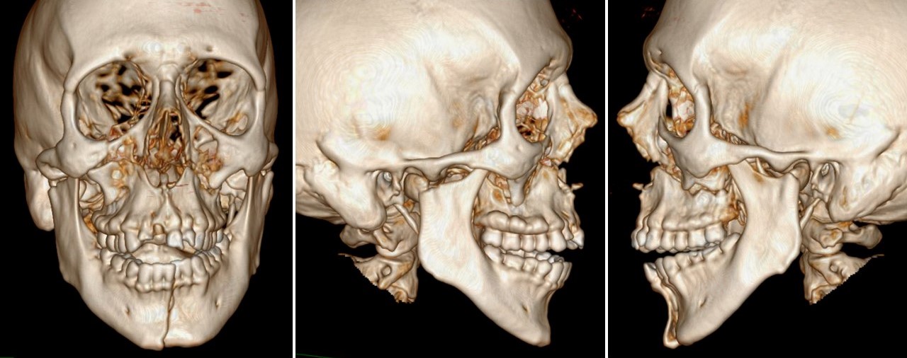 <p>Le Fort and Mandible Fractures