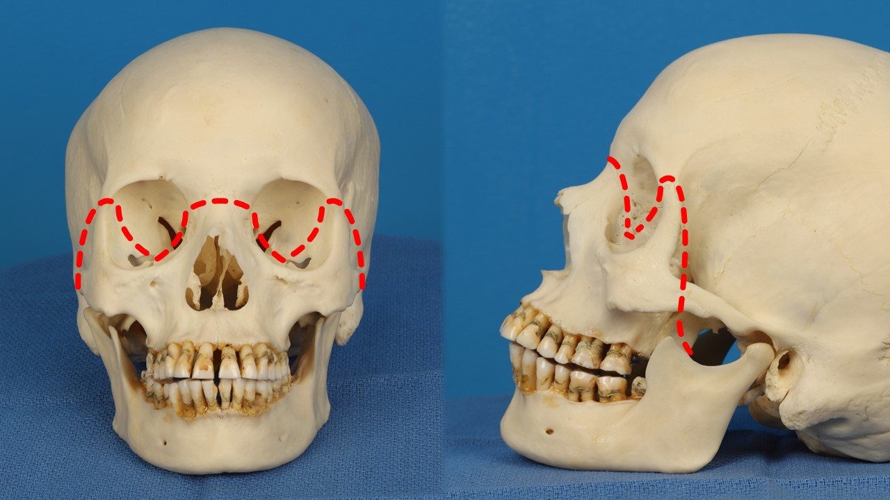 <p>Le Fort III Transverse Fracture