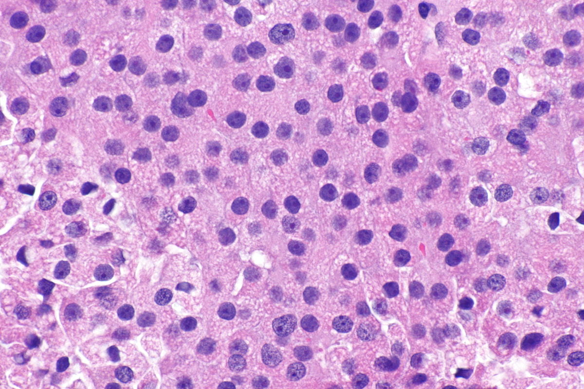 <p>Thyroid Carcinoma