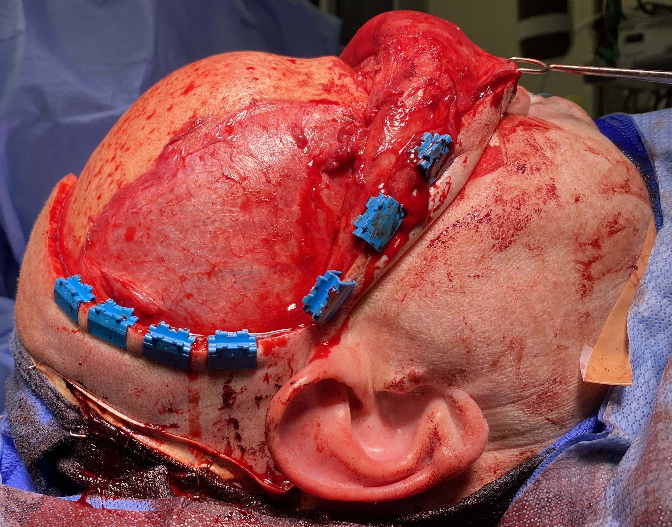 <p>Coronal Approach to the Craniofacial Skeleton