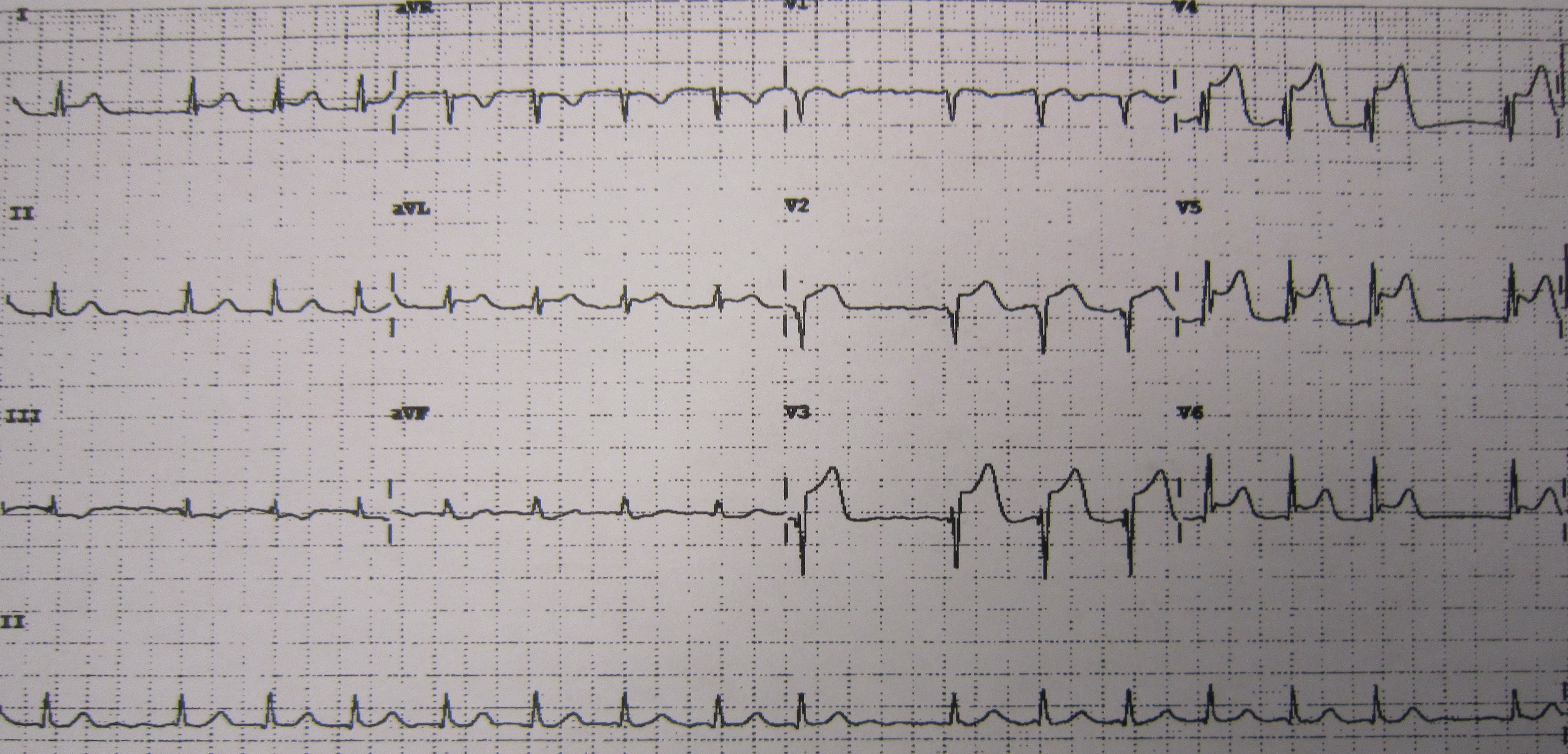 <p>Anterolateral Myocardial Infarction on Electrocardiography