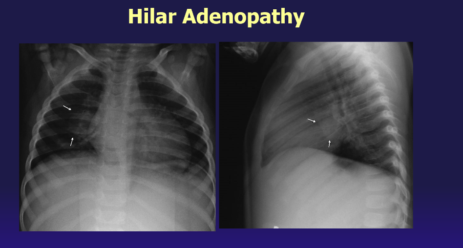 <p>Hilar Adenopathy