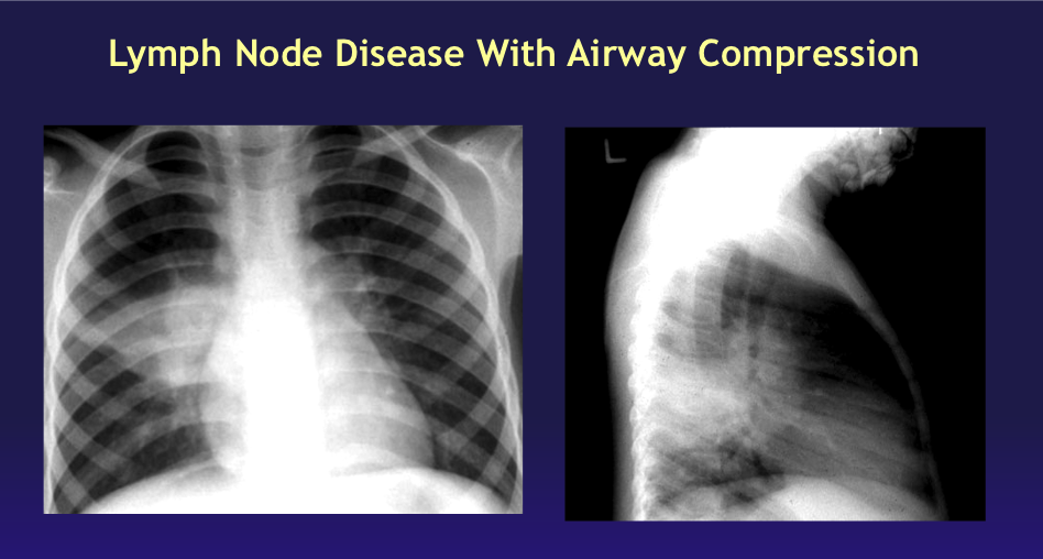 <p>Lymph Node Disease With Airway Compression