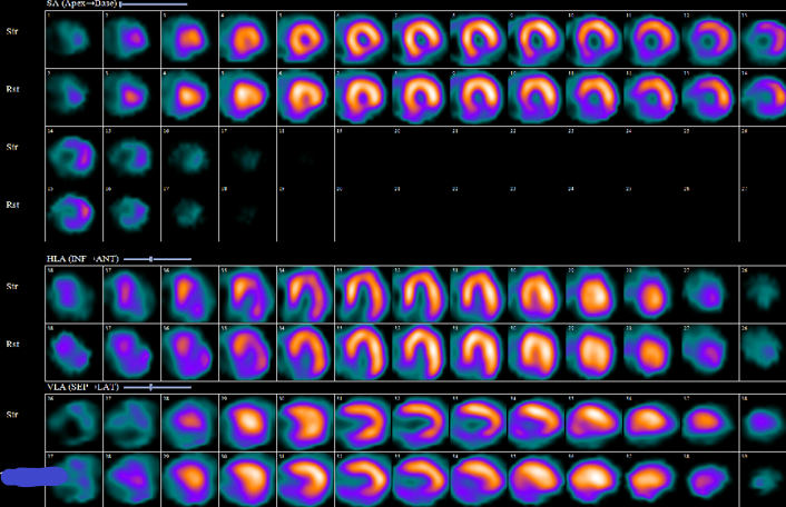 <p>Postinfarction Myocardial Perfusion Scan