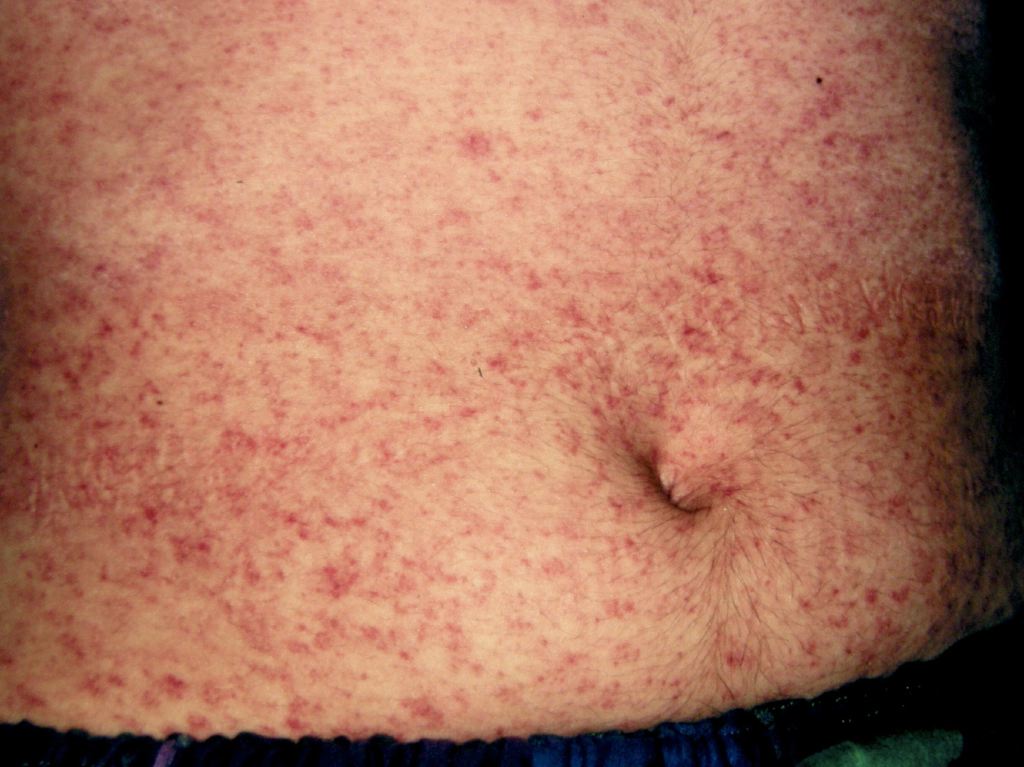 <p>Measles Infection</p>