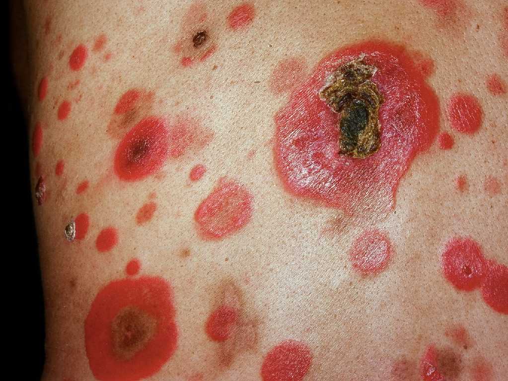 <p>Mycosis Fungoides</p>
