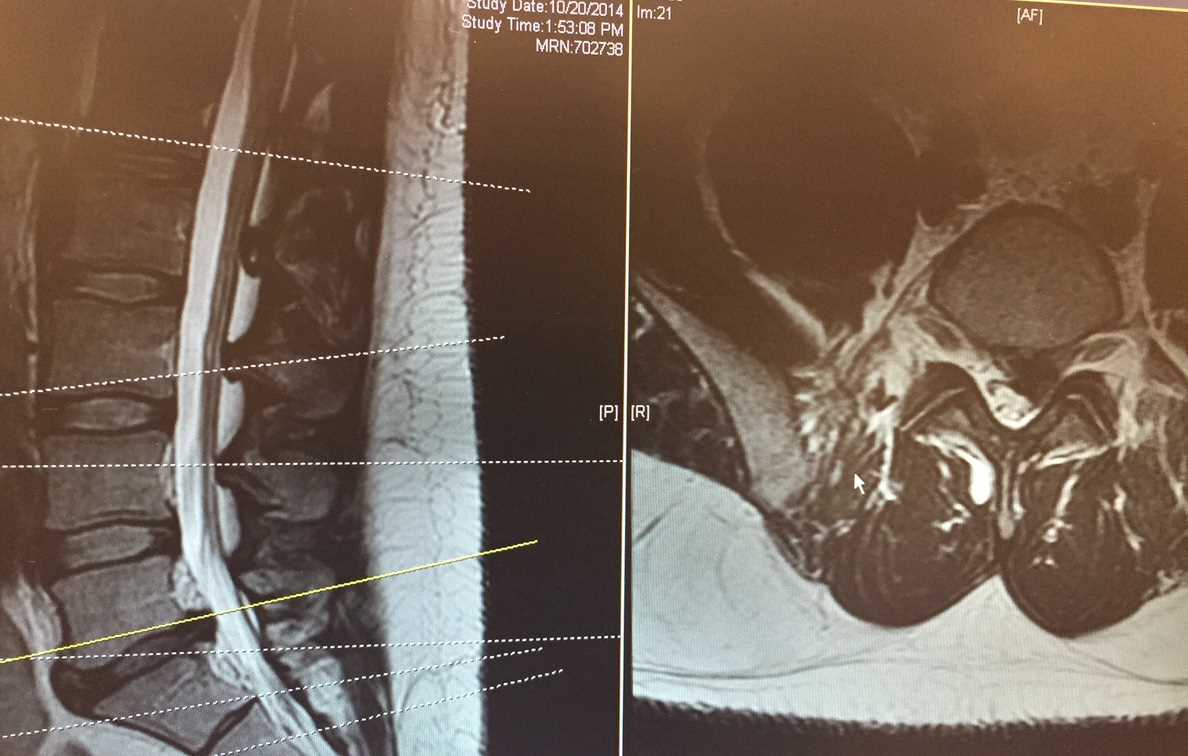 <p>Lumbar MRI. T2-weighted sagittal and axial views.</p>