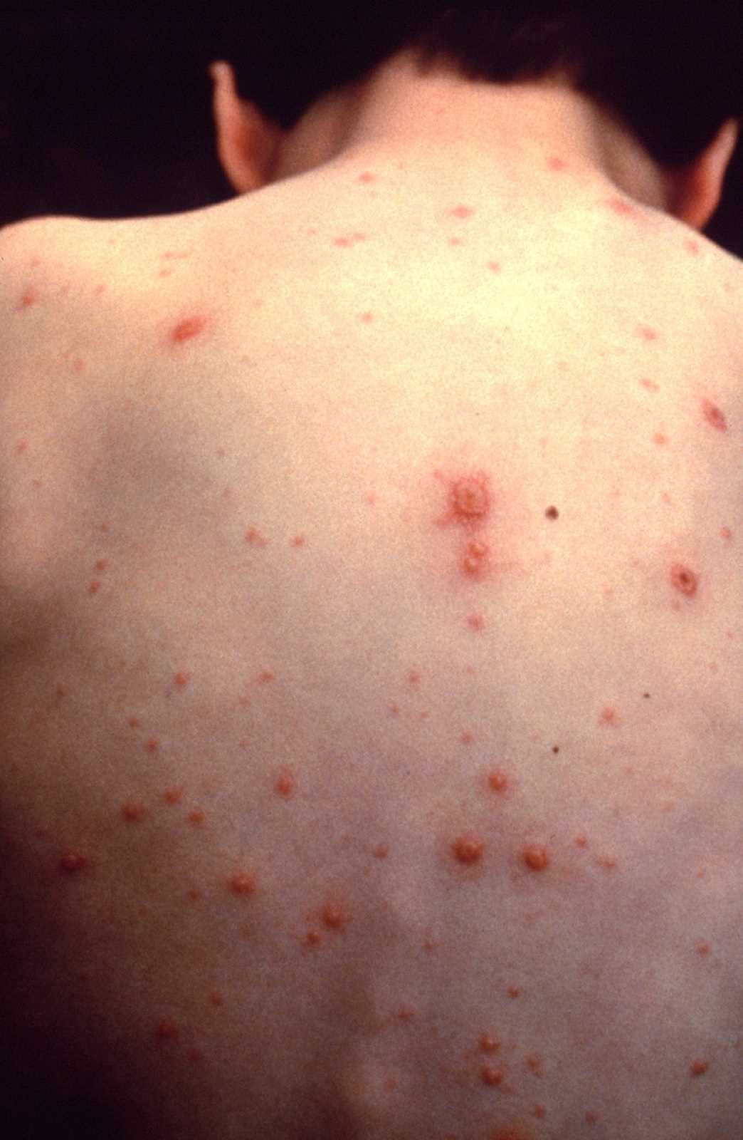 <p>Chickenpox (Varicella). Chickenpox in an unvaccinated child.</p>