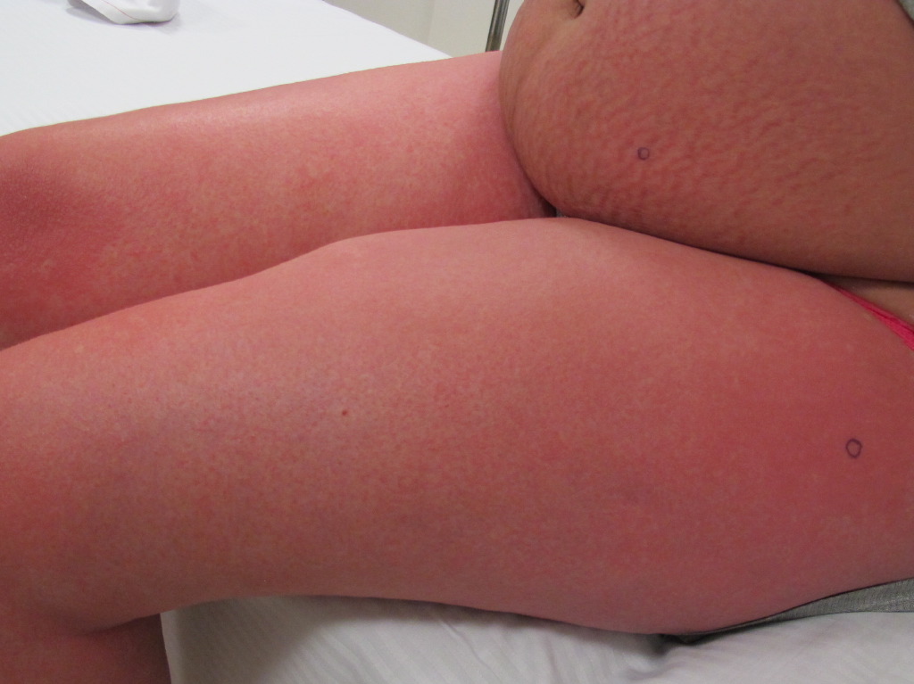 <p>Pruritic Urticarial Papules and Plaques of Pregnancy, PUPPP</p>