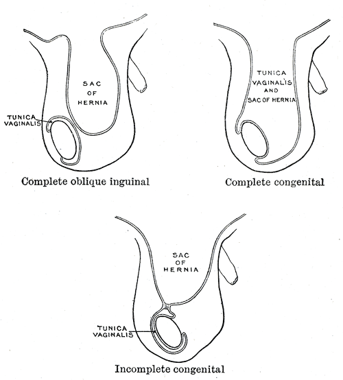 <p>The Large Intestine, Varieties of oblique inguinal hernia, Complete oblique inguinal hernia, Sac of Hernia, Tunica vaginal