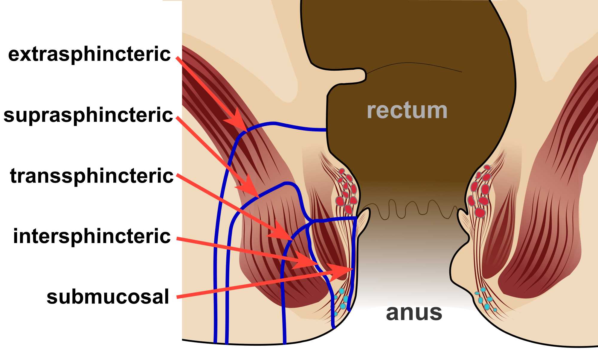 Different types of anal fistula
