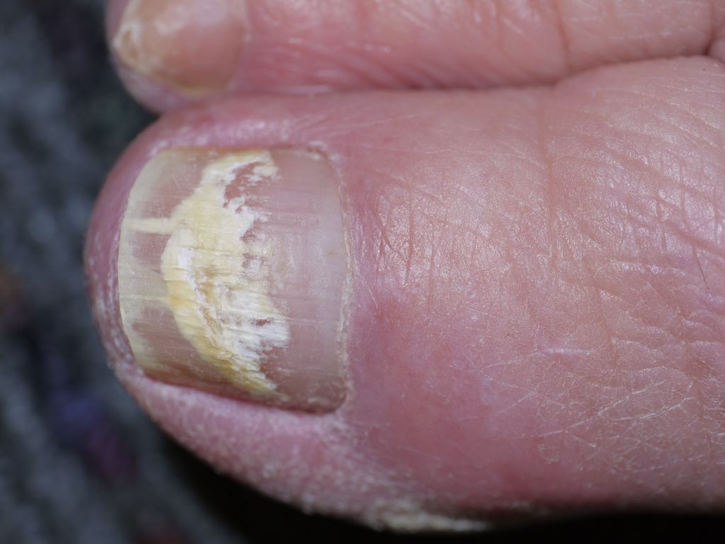 Practical Pearls in Cutaneous Fungal Infections and Onychomycosis