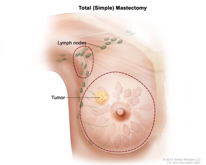 <p>Total Simple Mastectomy