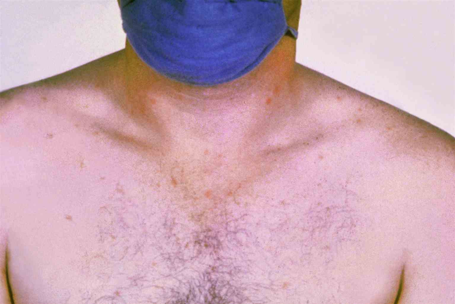 Rose spots on the chest of a patient with typhoid fever due to the bacterium Salmonella typhi