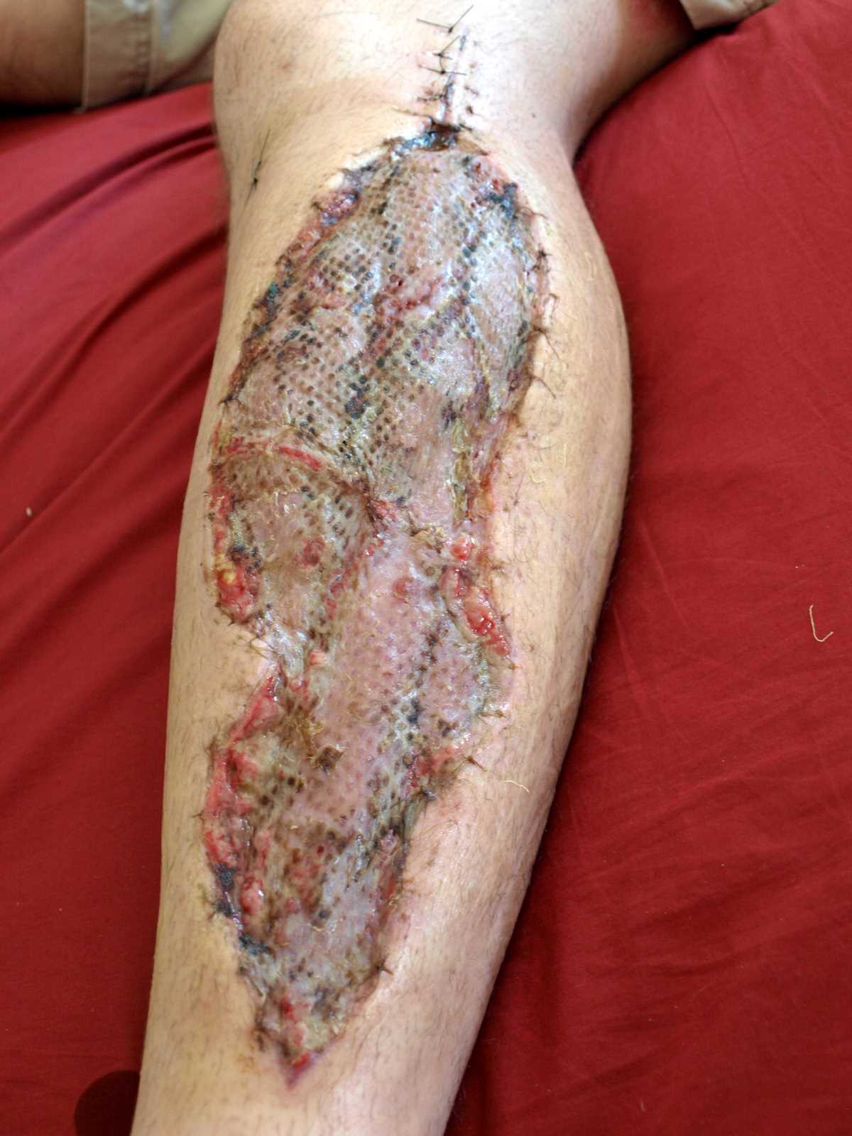 A fasciotomy one week after a skin graft had been applied. Wound was covered with a skin graft once pressure was relieved
