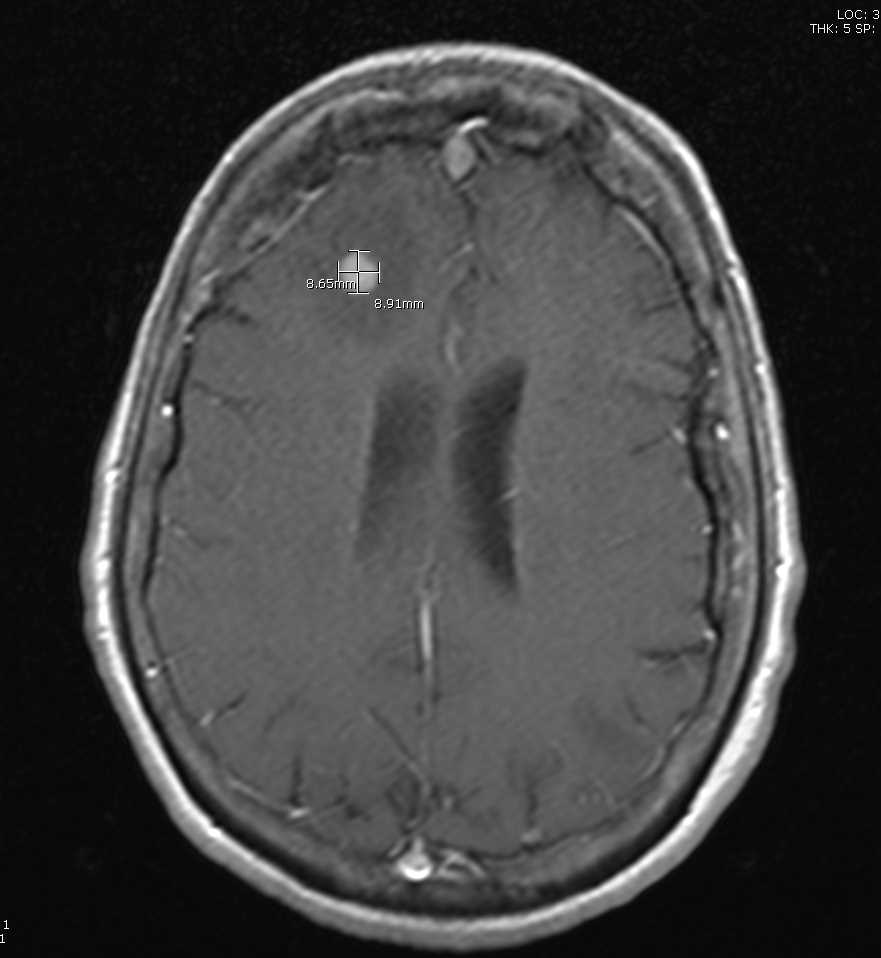 <p>T1-Weighted Postcontrast MRI Image Showing Lung Cancer