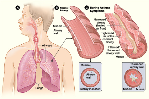 <p>Pathophysiology of Asthma