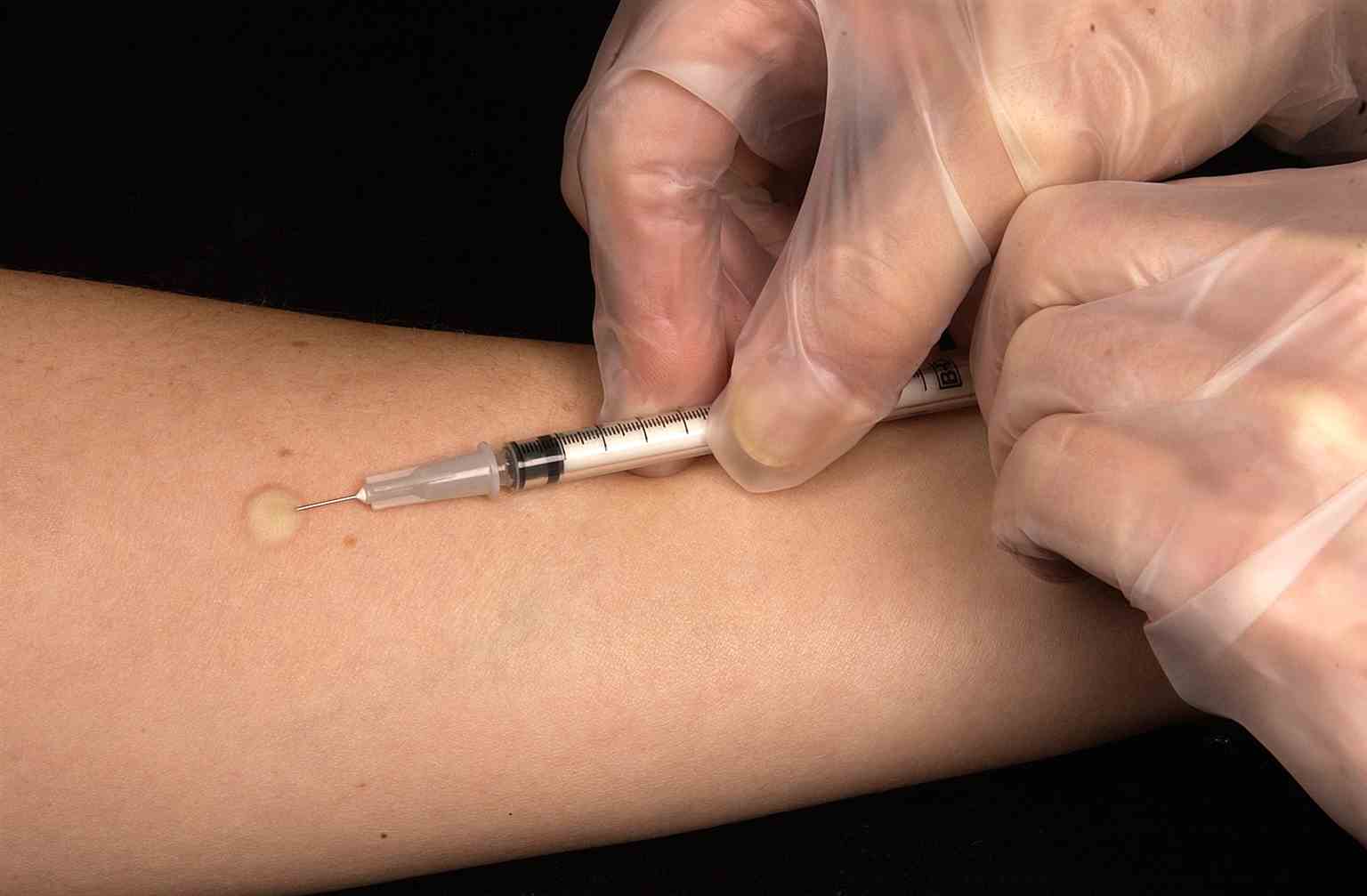 <p>This technician is in the process of correctly placing a Mantoux tuberculin skin test in this recipient&rsquo;s forearm, which will cause a 6mm to10mm wheal, i