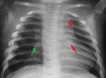 Rib fractures in an infant secondary to child abuse