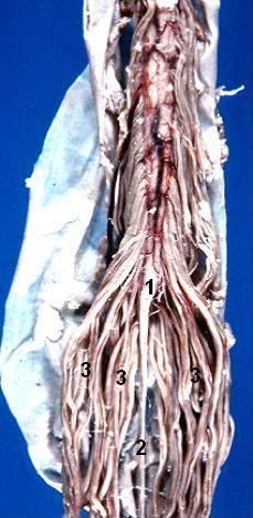 Human caudal spinal cord - Anterior view Conus medullaris Filum terminale Cauda equina (font: arial black, size: 14), 1) Conu
