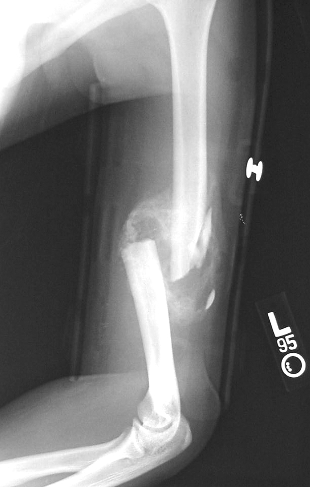 <p>Comminuted Humeral Shaft Fracture