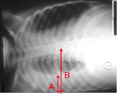 <p>Pleural Effusion Radiograph, Lateral Decubitus