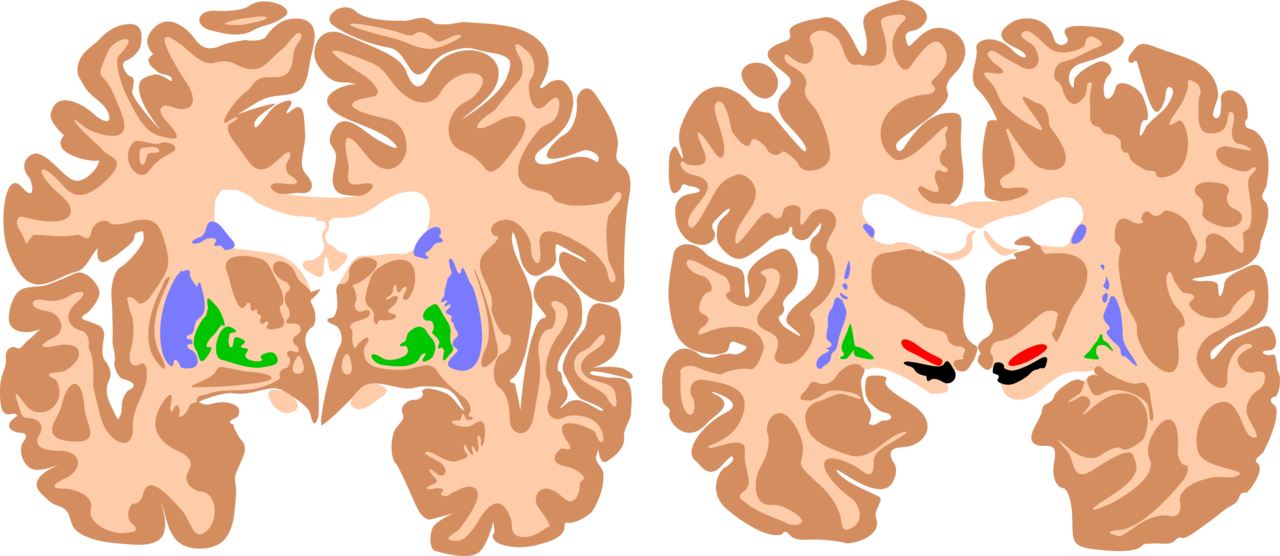 <p>Basal Ganglia, Cerebral Palsy Brain