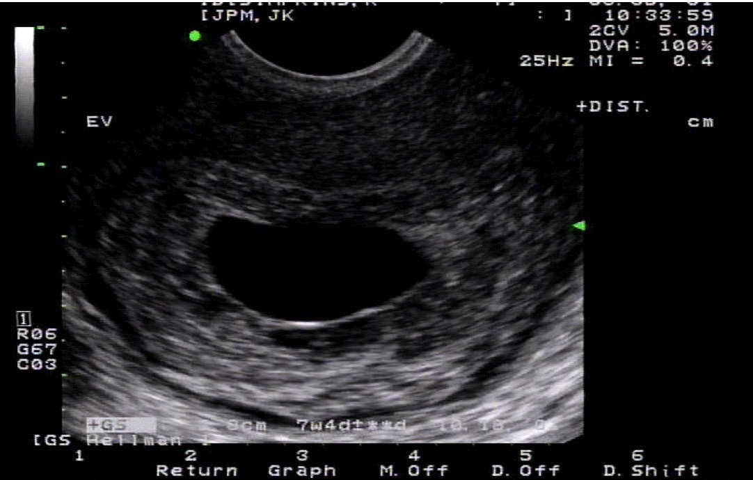 <p>Endovaginal Ultrasound of the Uterus
