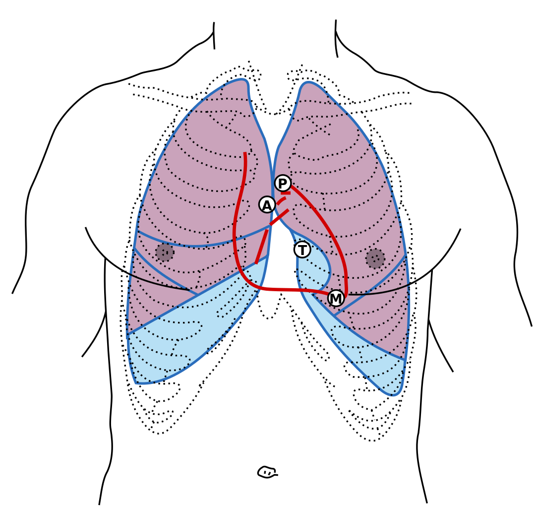 Front of thorax, showing surface relations of bones, lungs (purple), pleura (blue), and heart (red outline)