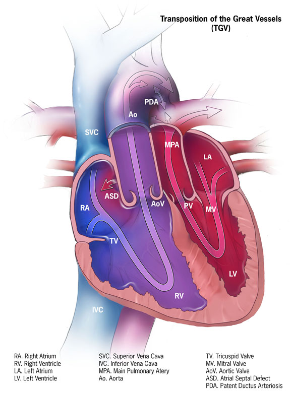 <p>Dextro-Transposition of the Great Arteries (d-TGA)</p>