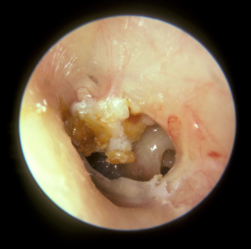 The large mass of white keratin debris in the left upper quadrant of this left tympanic membrane is a cholesteatoma