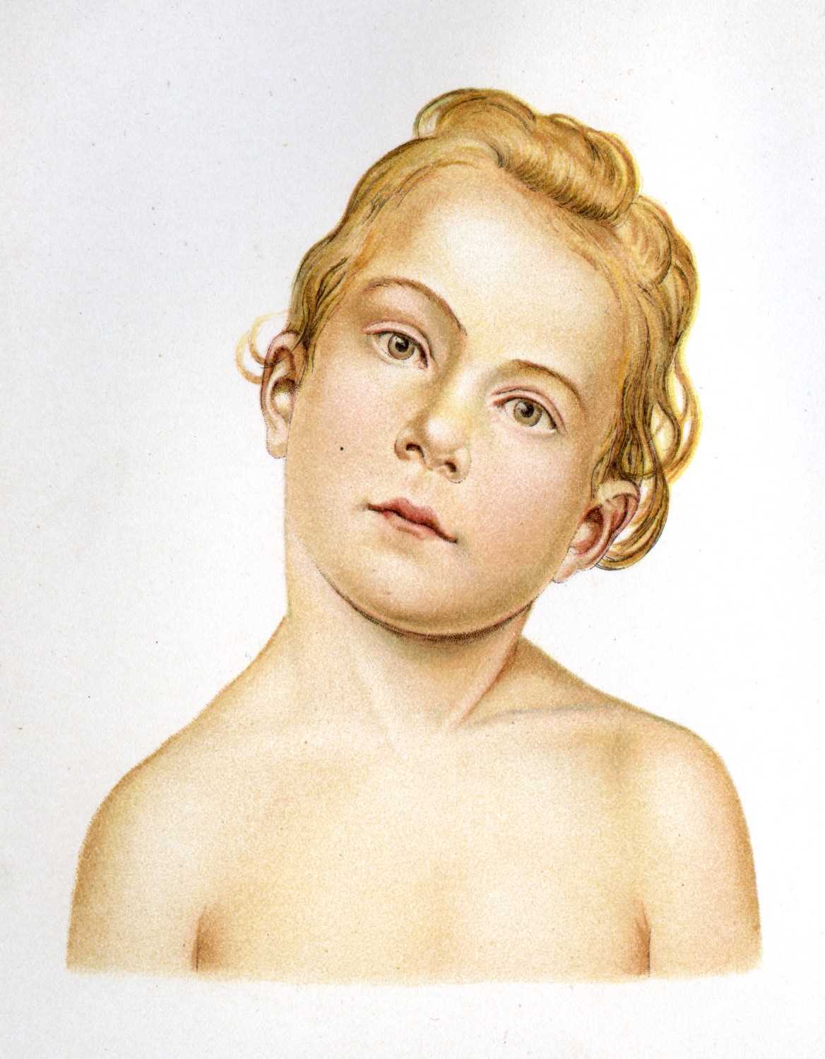 <p>Child with Torticollis. An illustration of findings of a child with untreated torticollis.</p>
