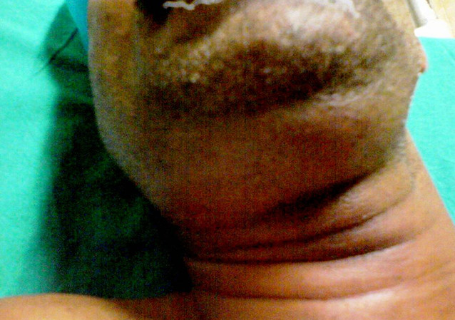 Swelling in the submandibular area in a patient with Ludwig's angina