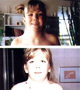 <p>Girl With Turner Syndrome. Photos showing before and immediately after her operation for neck-webbing.</p>