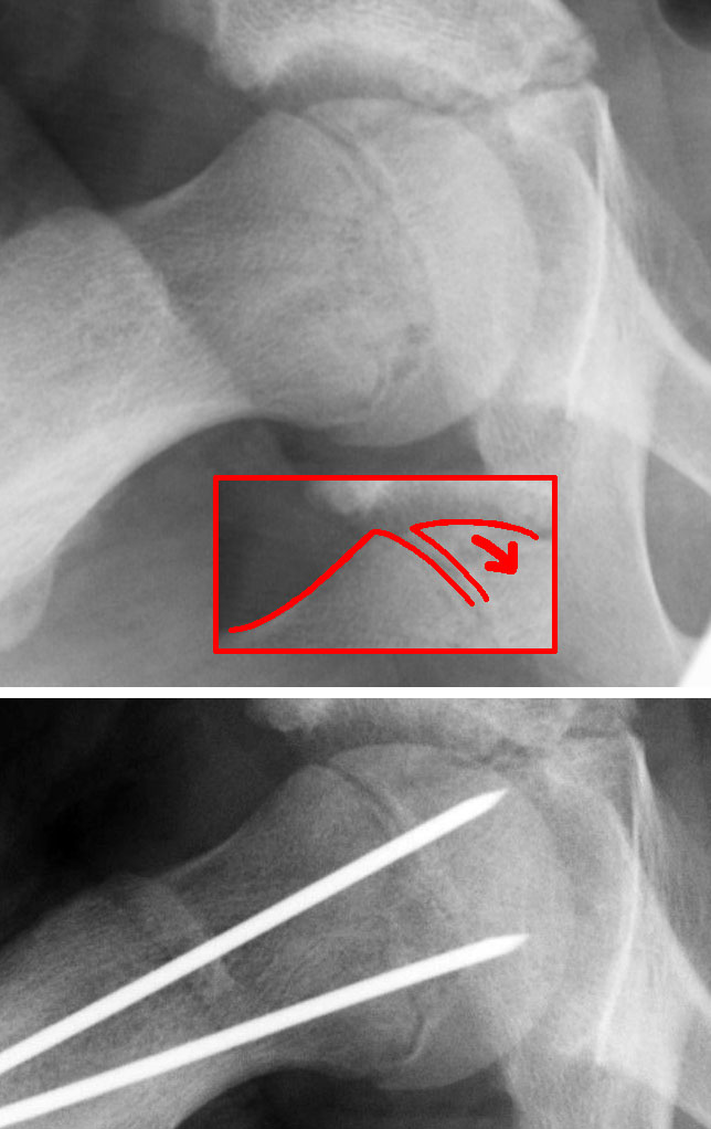 X-ray showing a slipped capital femoral epiphysis, before and after surgical fixation.