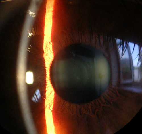 <p>Cornea, Iris, and Lens, Slit Lamp Image
