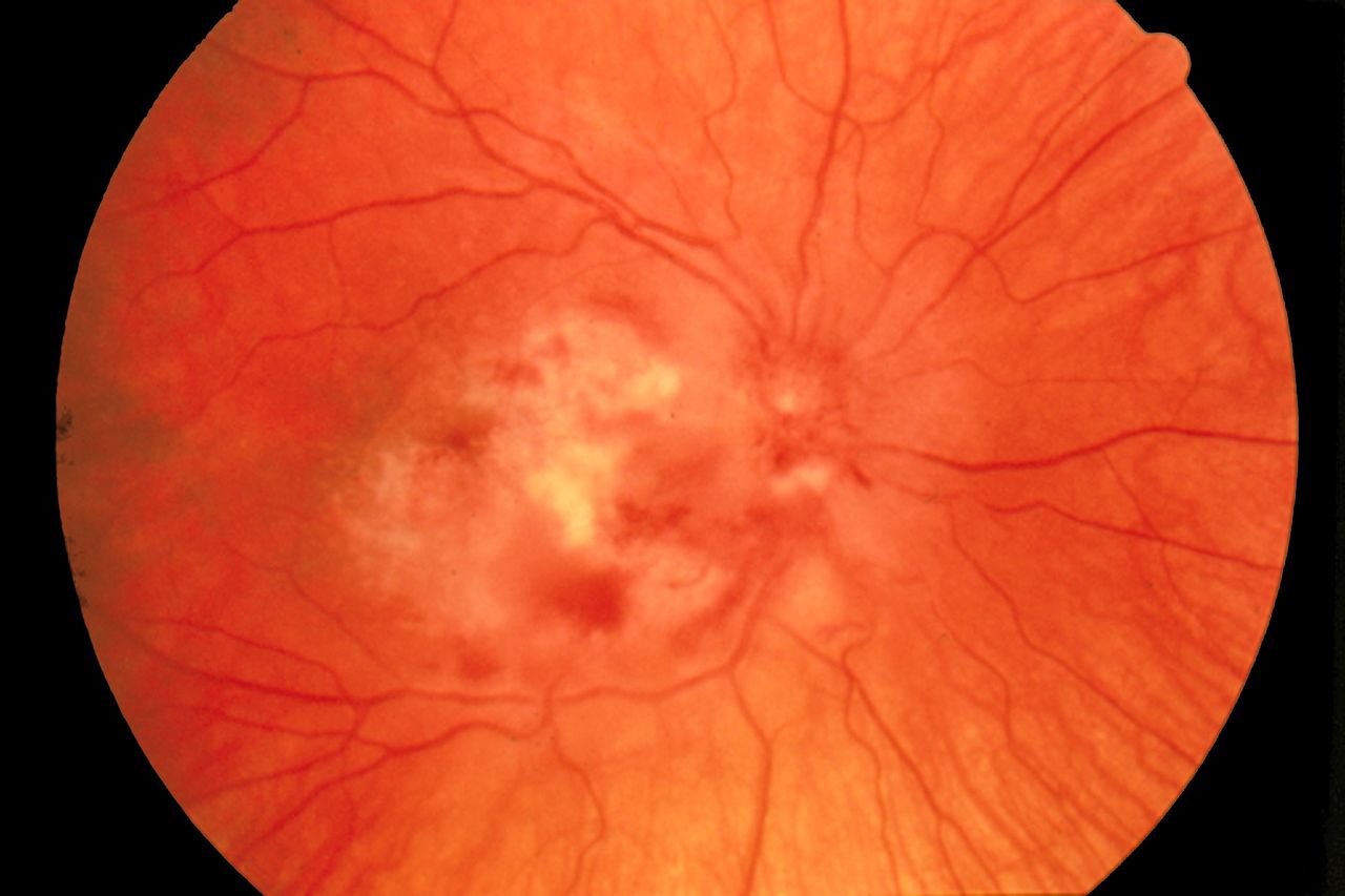 <p>Cytomegalovirus Retinitis. The image depicts a view of a fundus affected by cytomegalovirus retinitis.</p>
