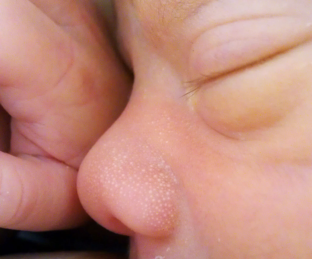 Milk spots (milia) on the nose of a 1-week old infant.