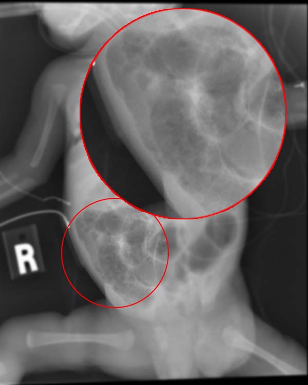 <p>Radiograph of an Infant With Necrotizing Enterocolitis</p>