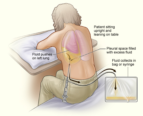 The illustration shows a person having thoracentesis