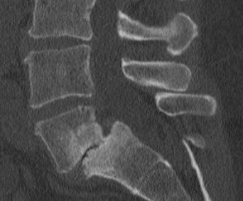 <p>Lumbar Spine Sagittal CT of L5-S1, Grade II Spondylolisthesis</p>