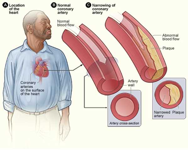 Atherosclerosis as a result of coronary heart disease.