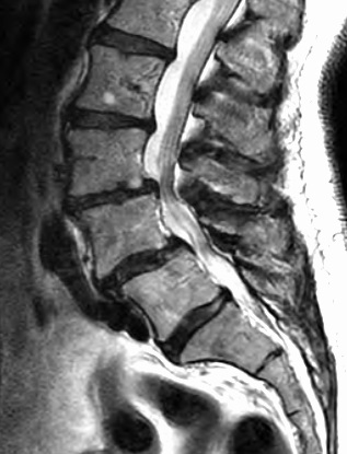<p>Sagittal MRI of Lumbar Spine With Spondylolisthesis at L3-4 and L4-5.</p>