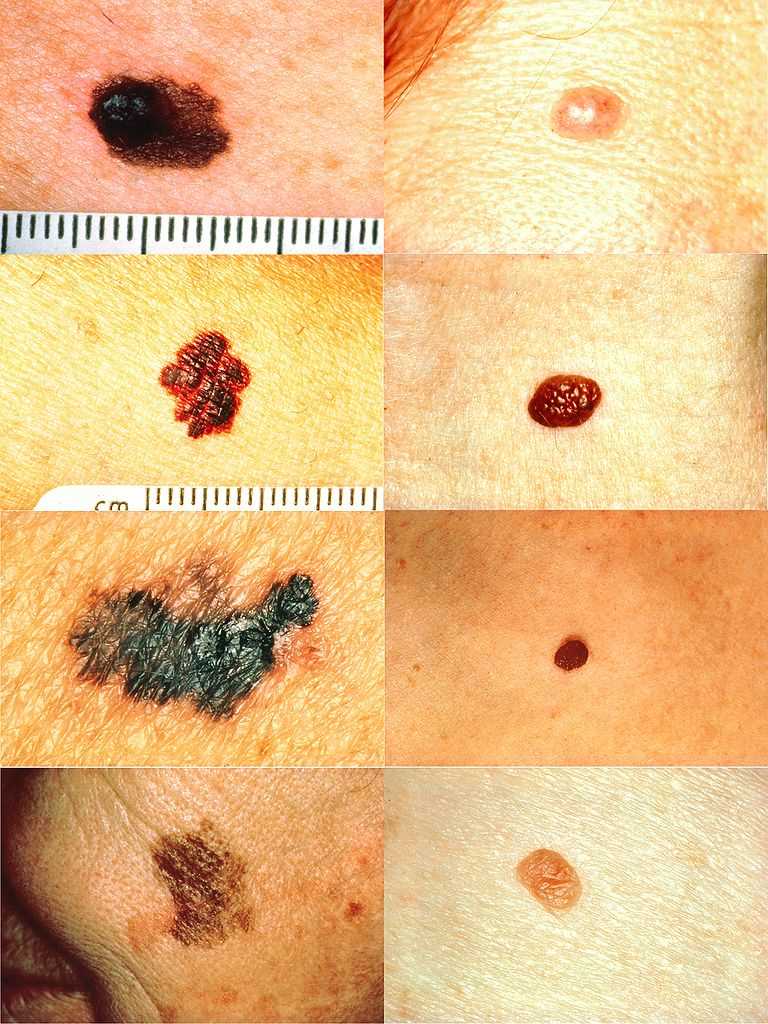 <p>Part of the ABCDs for Detection of Melanoma