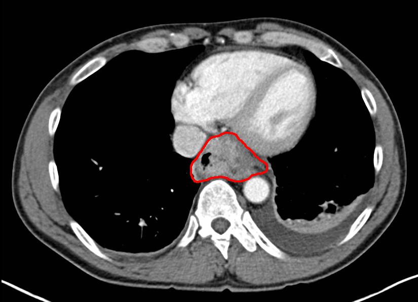 Cancer of the esophagus, CT with contrast, axial image