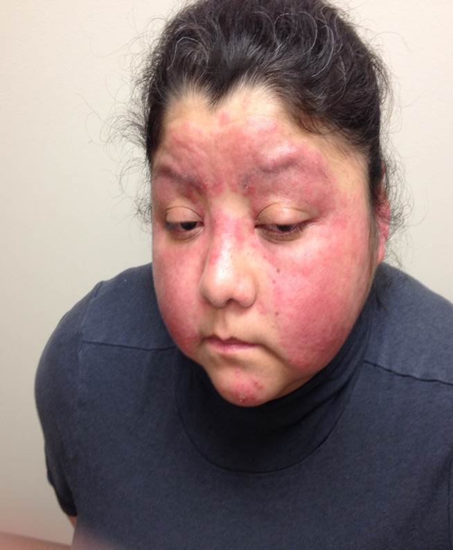 <p>Rash, Face. Rash on the face presents on bilateral cheeks with sparing of the nasolabial folds.</p>
