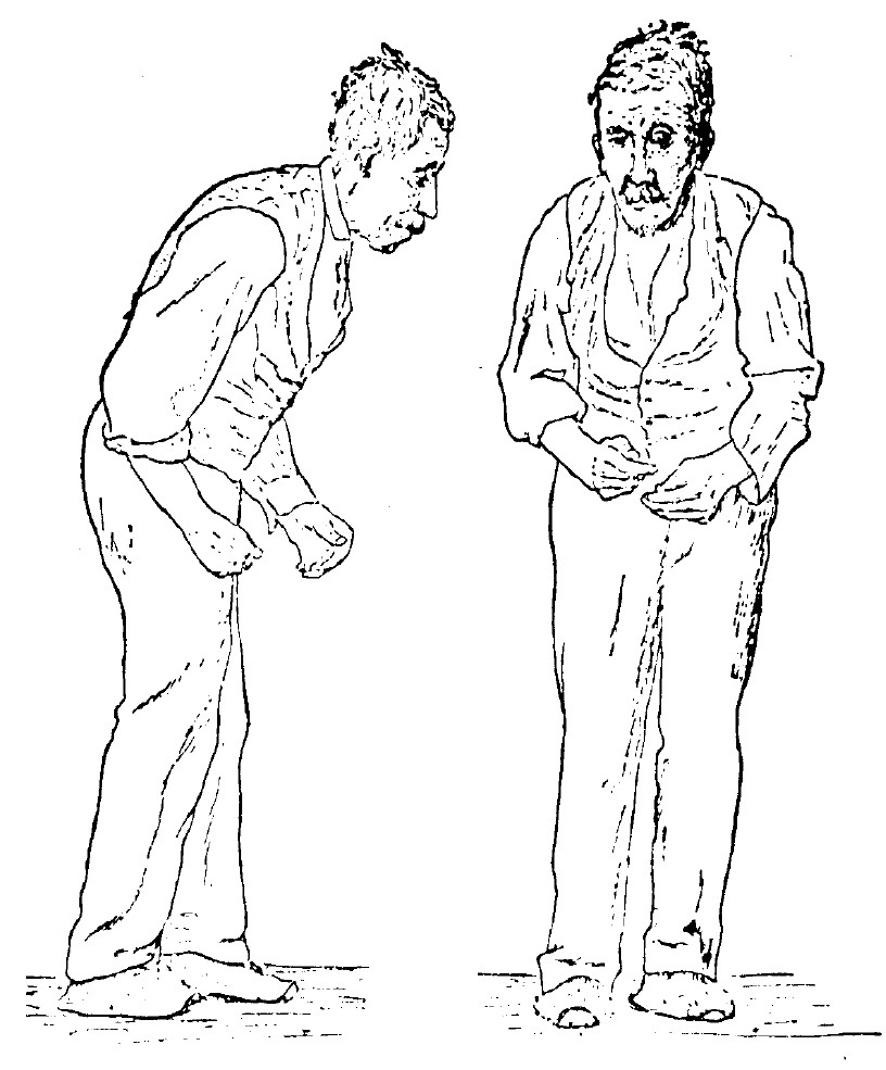 Sir William Richard Gowers, neurologist, researcher and artist, drew this illustration in 1886 as part of his documentation of Parkinson's Disease