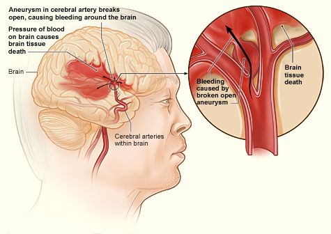 The illustration shows how a hemorrhagic stroke can occur in the brain