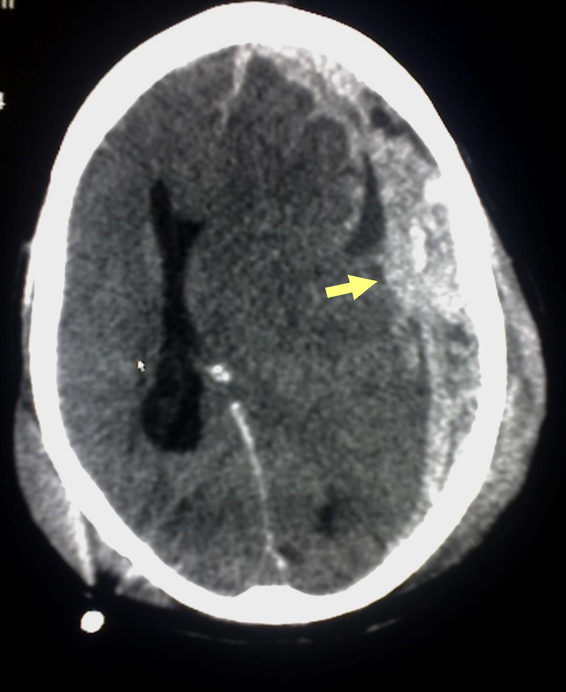 <p>Subdural Hematoma Detected on Head CT