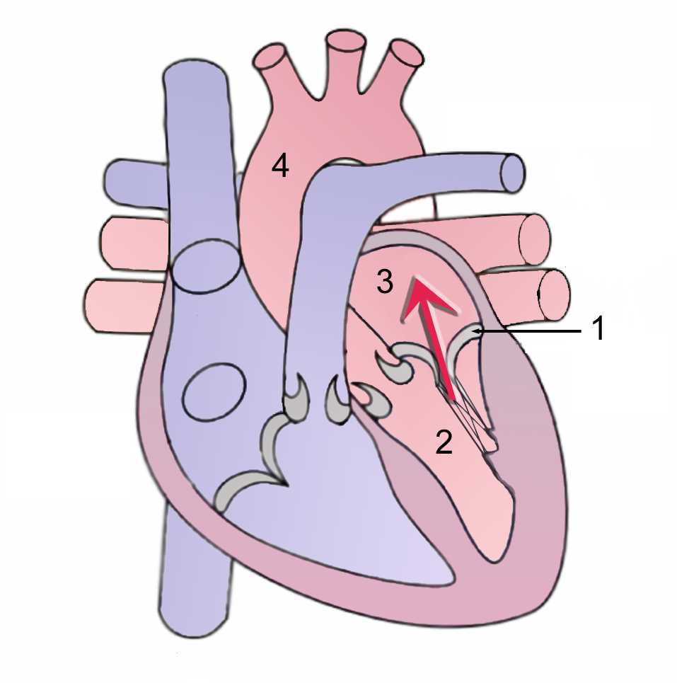 Mitral regurgitation/During systole, contraction of the left ventricle causes abnormal back flow (arrow) into the left atrium